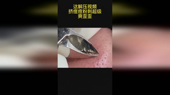 最新擠膿包視頻，見證變化的力量，自信與成就感的誕生之地