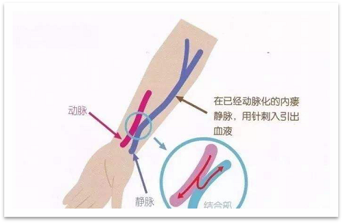 靜脈瘺最新資訊，掌握最前沿的健康信息